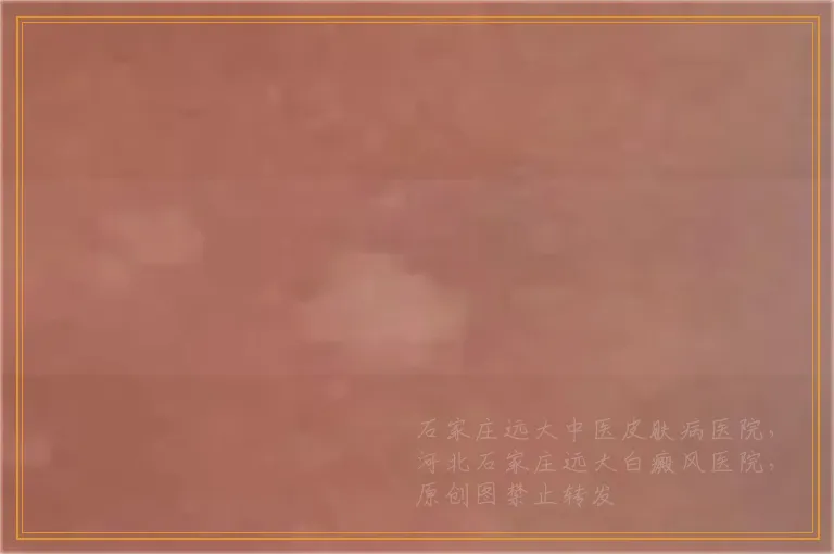 小白点是不是白癜风如何判断准确