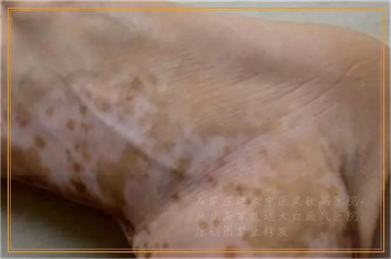 背上出现零散的小白点是咋了