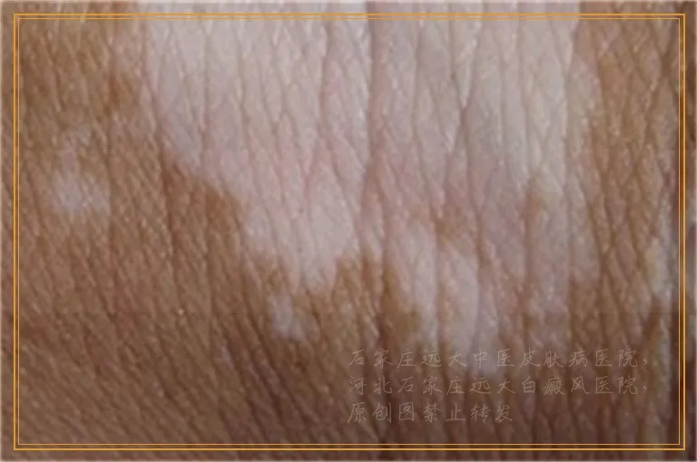 结疤好了以后出现白斑是白癜风吗