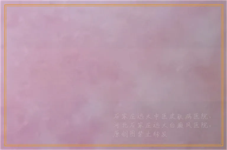 额头白一块是不是白癜风做什么检查