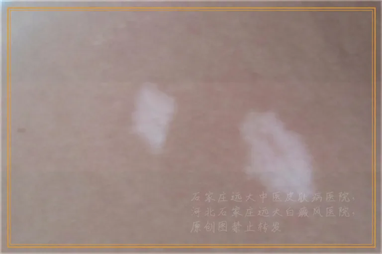 脸上的小白点患者怎么分辨是不是白癜风