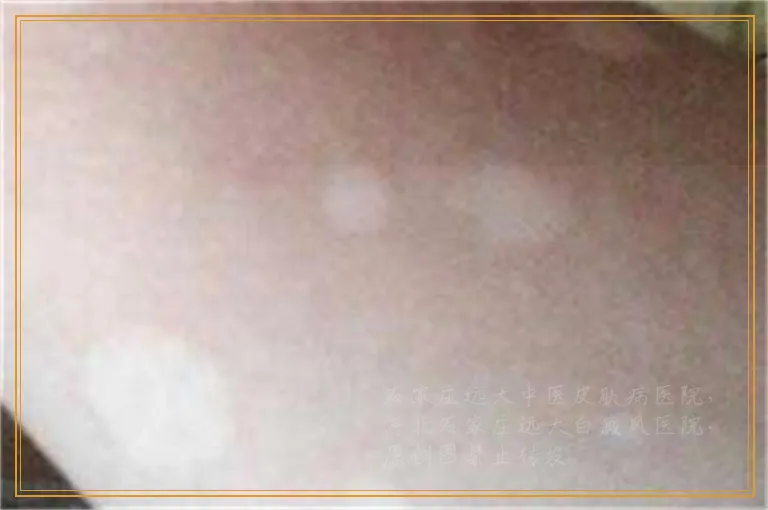 身上出现白斑的原因都有哪些