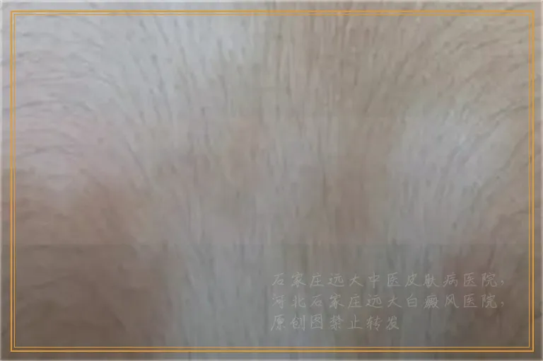 腿上出现小片白点是怎么回事