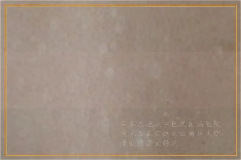 皮肤暴晒后发白怎么处理