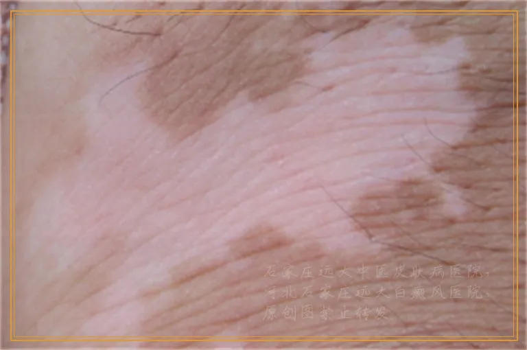 胳膊上皮肤出现许多小圆白点怎么回事