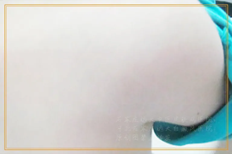 胸口处出现了一块白斑会是白癜风吗