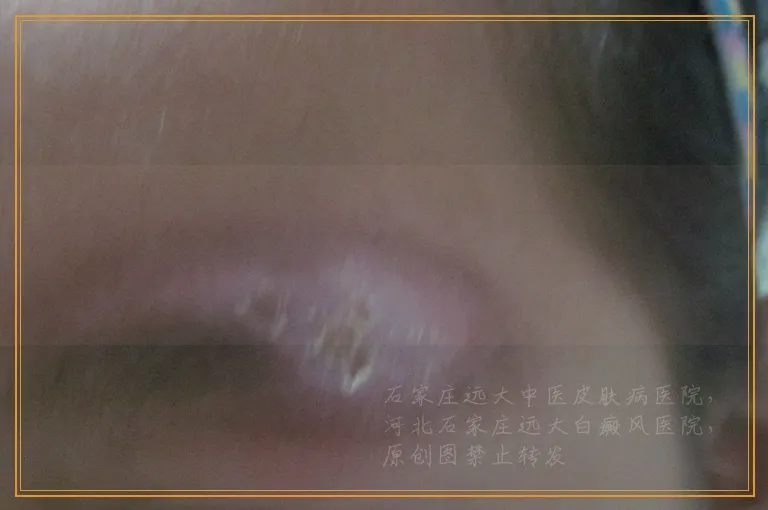 宝宝腿上皮肤白一块是怎么回事