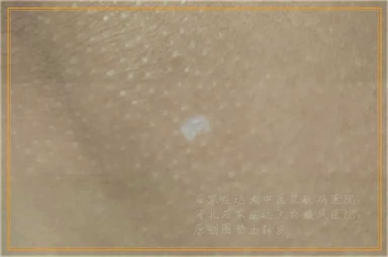 眼角有一块白癜风好治吗