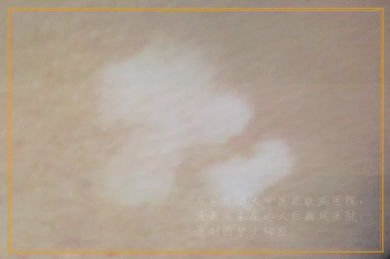 腿上长了很多小白点不痛不痒怎么回事