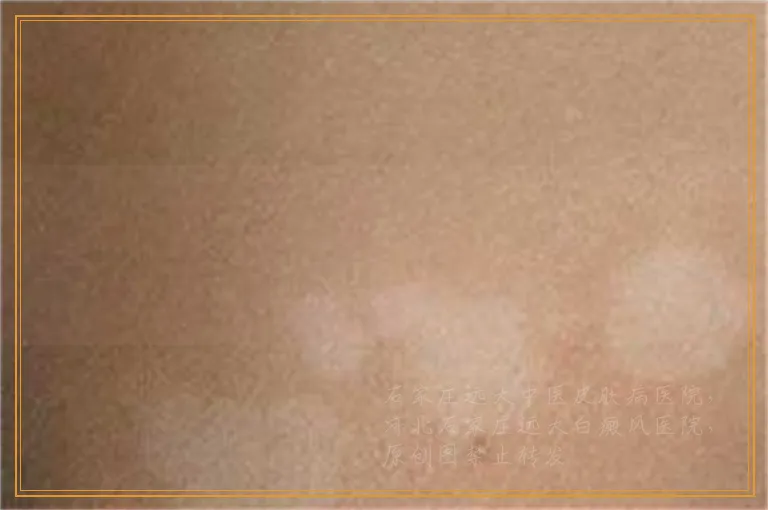 白癜风会出现哪些并发症