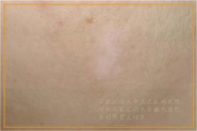 额头出现小白点是不是白癜风