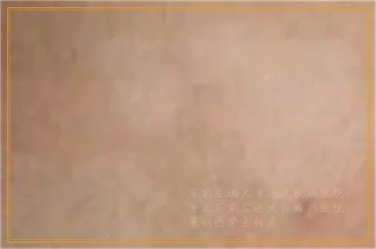 脸上一块白一块白是怎么回事