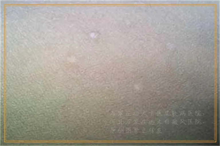 皮肤突然出现白块是怎么了