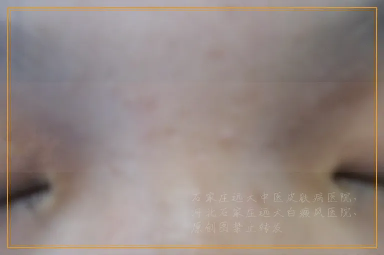 白癜风突然出现扩散是为什么