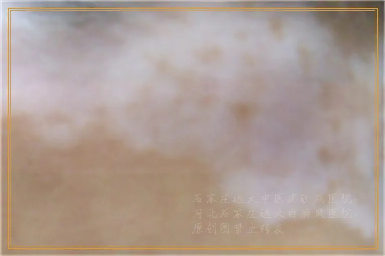 手背上好多小白点是怎么回事