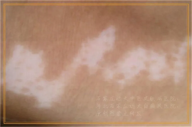 暴晒后皮肤先红后白怎么回事