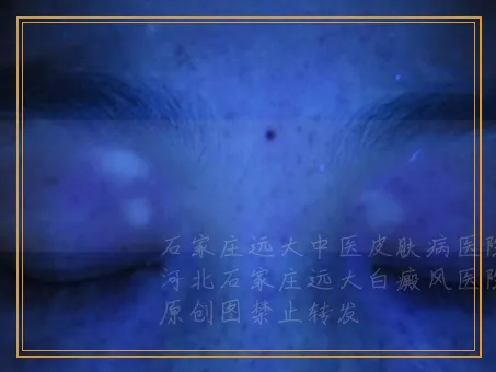 白癜风开始是小白点点的样子吗