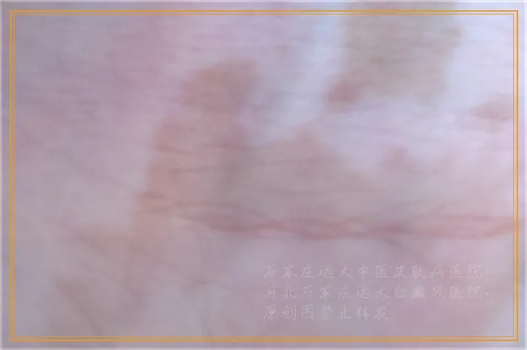 308激光治白斑出现起泡怎么办