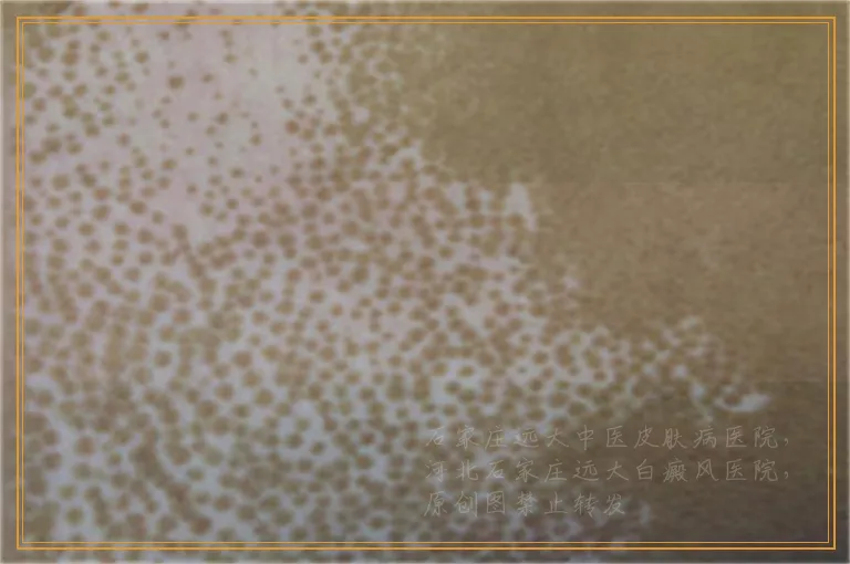 宝宝嘴角的皮肤变白一块怎么回事