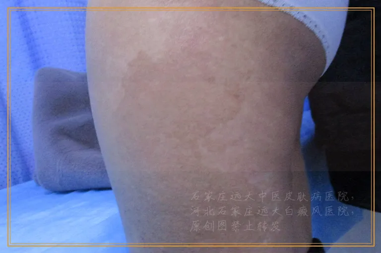 腿上有八九块小白点是怎么回事