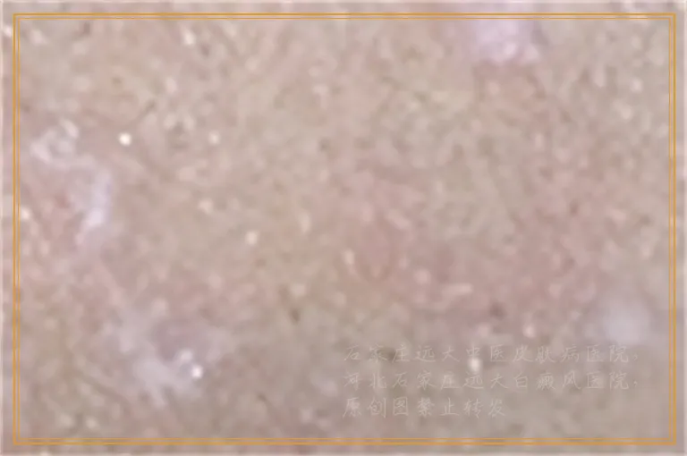 女性脸上出现一小块白斑做伍德灯能检查出来吗