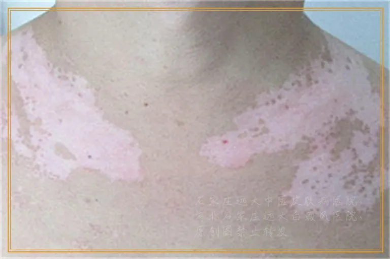 孩子身上的小白点是白癜风吗