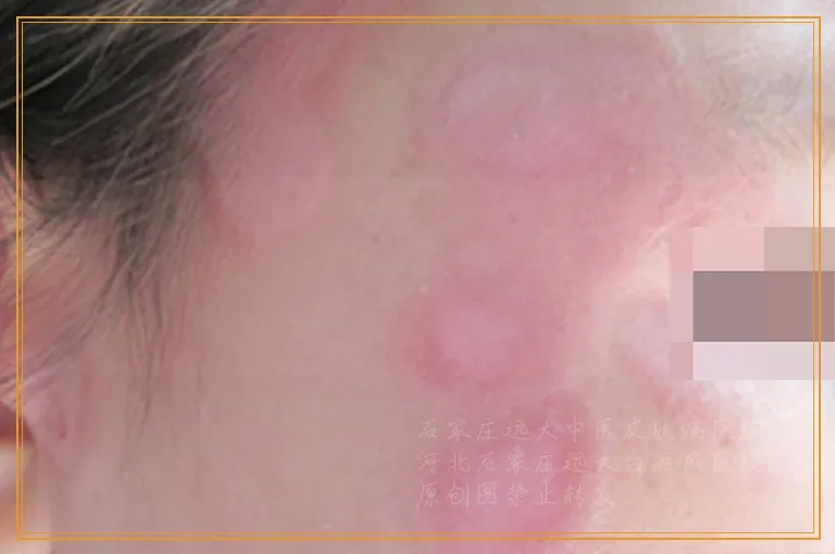 白癜风是如何出现的病因有哪些