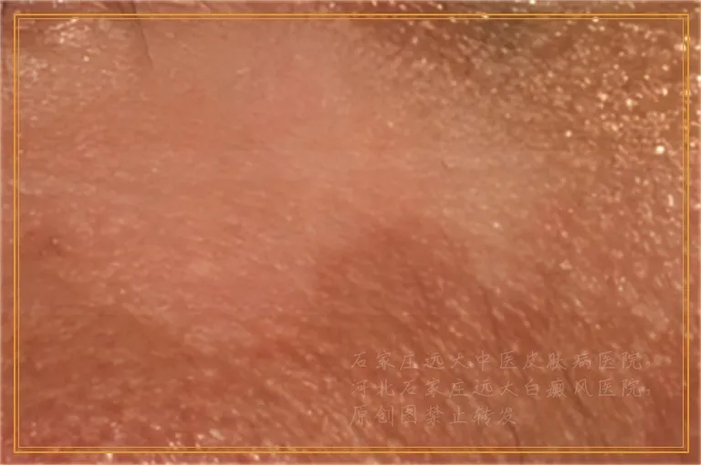 腰部有一块白色胎记一样的东西是白癜风吗