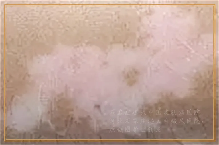 新生儿四肢突然出现白色斑点怎么回事