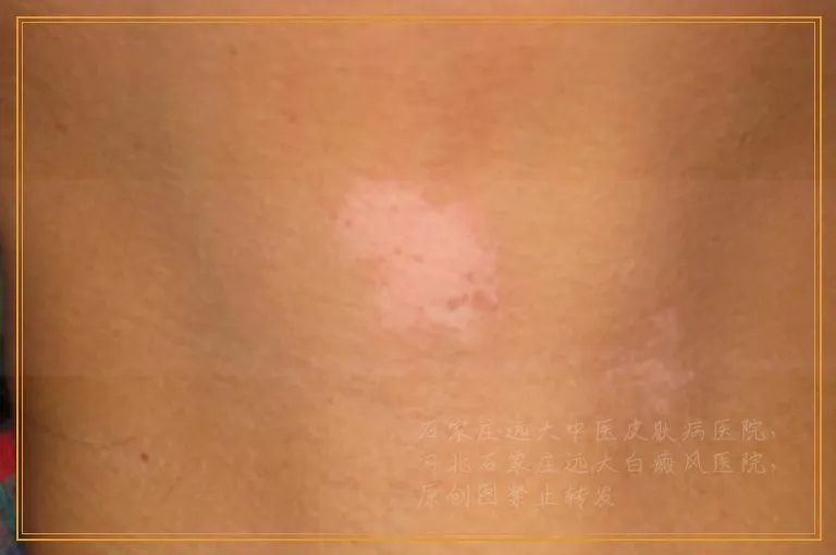 白癜风扩散期边缘会出现什么样子