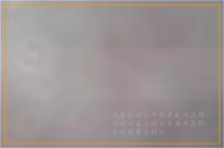 白癜风照光出现瓶颈期能停止一段时间吗