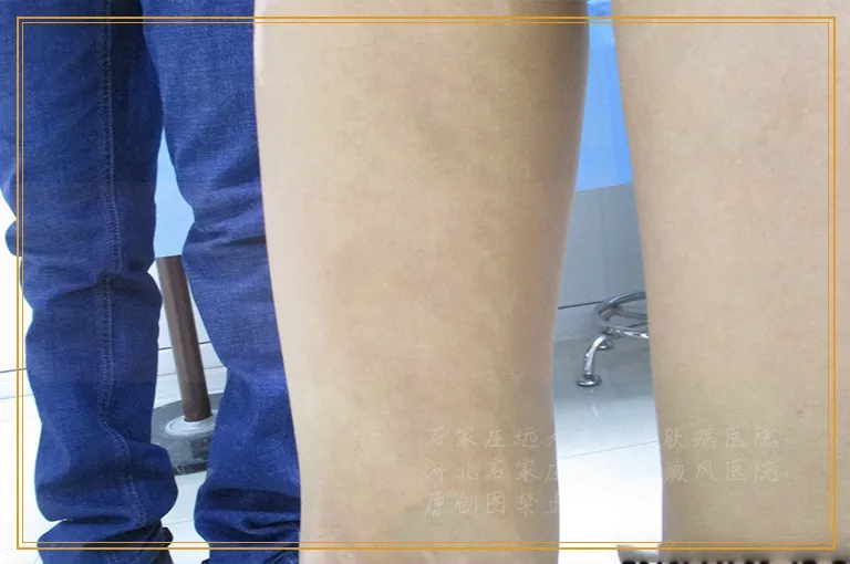 出现这些症状 小心是早期的白癜风