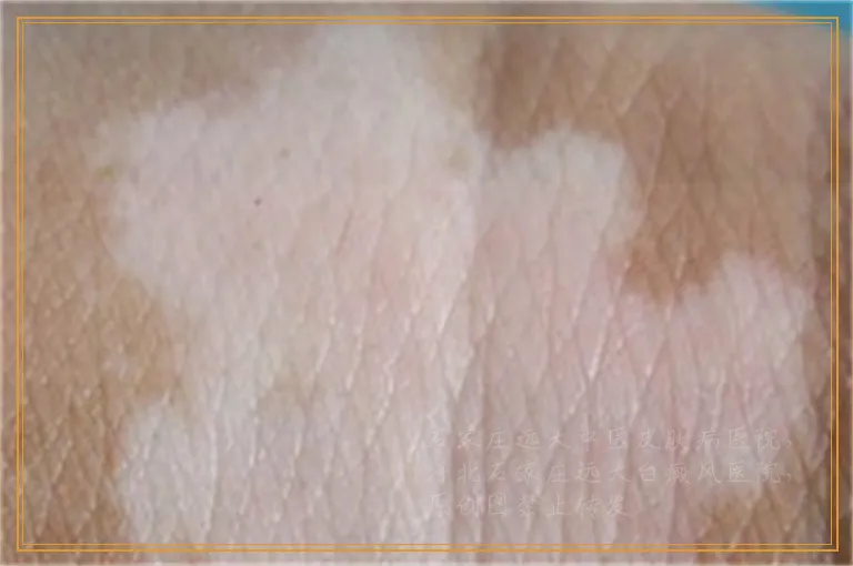 脖子后面有一块白是不是白癜风