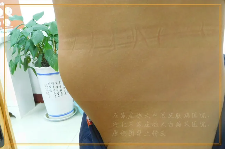 腿上有一块白是不是白癜风怎么判断