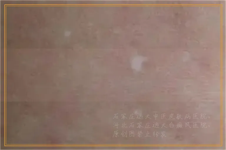 左腿上面一段白一块是怎么回事