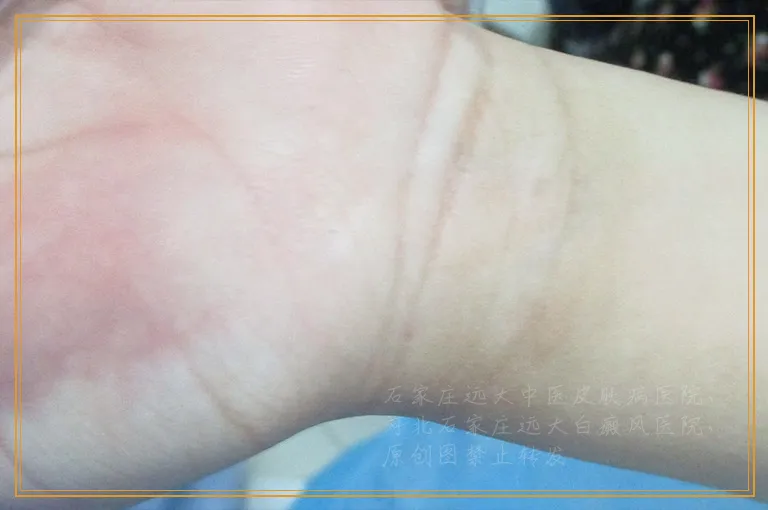 白癜风照308出现小黑点正常么