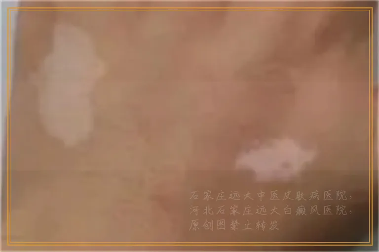 身上出现白斑怎么判断是不是白癜风