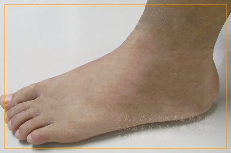 皮肤突然出现白斑是什么情况