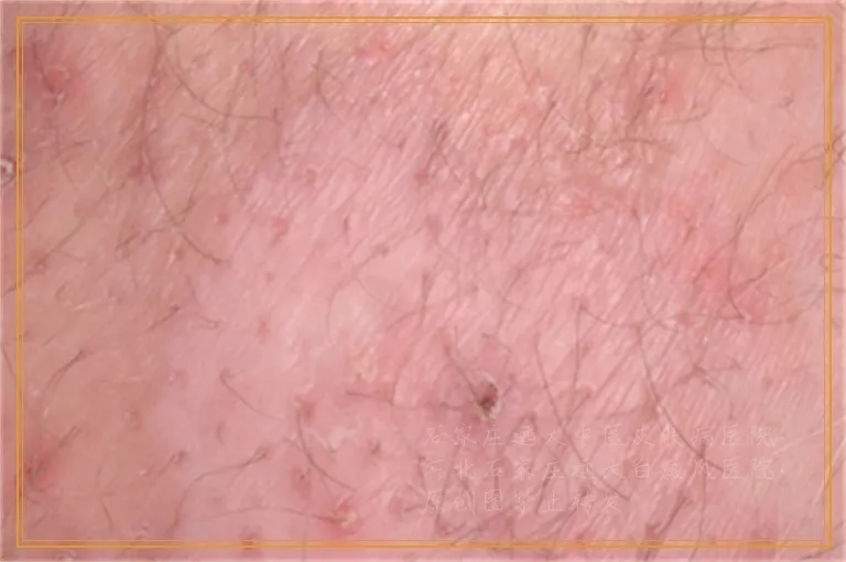 宝宝大腿根那白一块咋回事