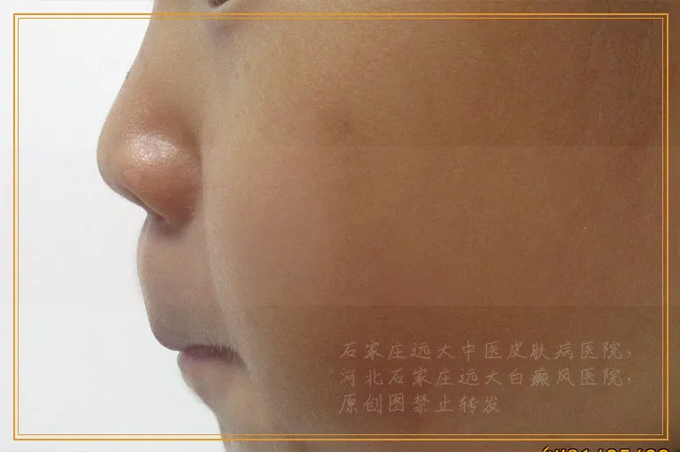 宝宝脖子附近有一块白斑是什么原因