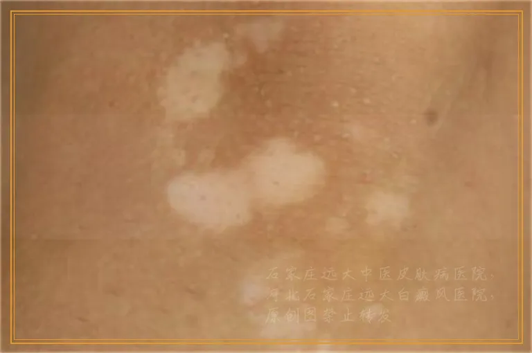 八岁的孩子脸上出现白斑该去哪治疗