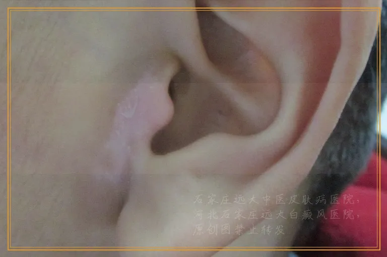 小孩身体有一块块的白色