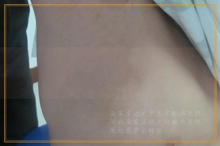 嘴角上有一块白斑会是白癜风吗