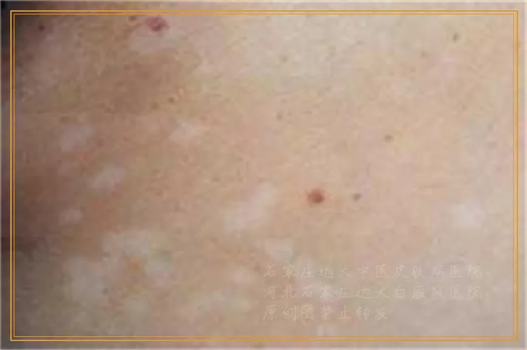 大腿根部有一块白斑是白癜风吗