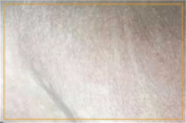 额头长小白点会自己好吗