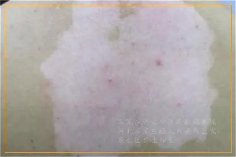 大拇指上皮肤白一块怎么回事