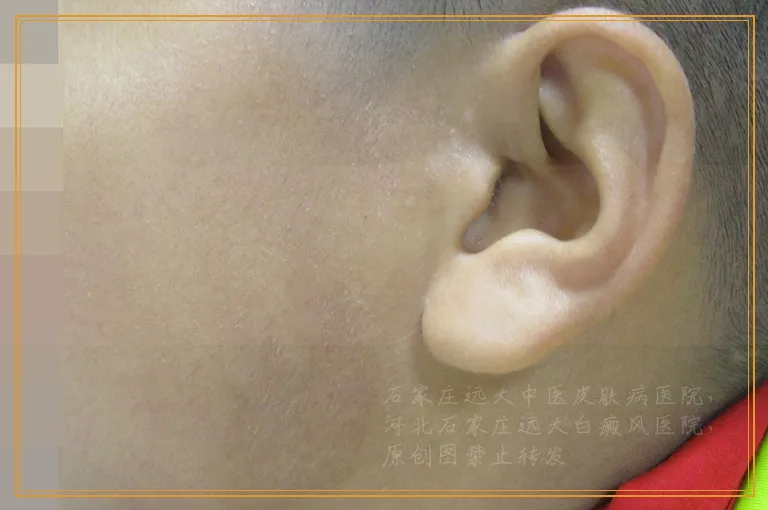 孩子脸上出现白色斑块如何判断是不是白癜风