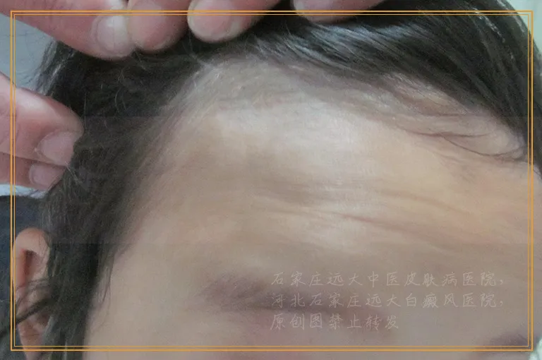 嘴边出现一块硬币大小白块是不是白癜风