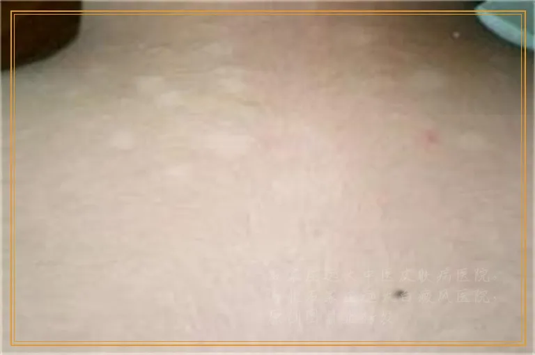 脸部小白点会是白癜风吗白斑症状图
