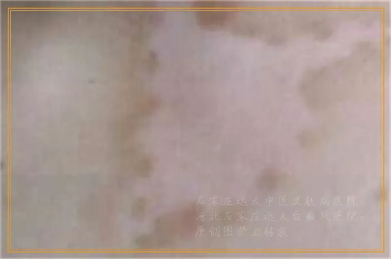 孕妇大腿内侧皮肤变白一块怎么回事